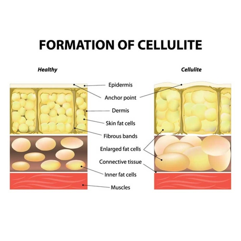 Anticeluliten-masazor-Celluless-MD-don_100028